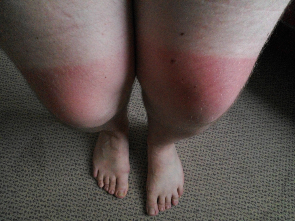 Jason's sunburned knees